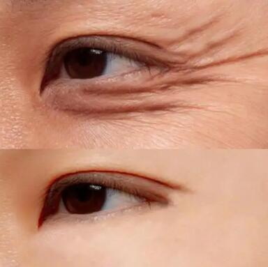 前后对比:吸雕双眼皮手术的神奇效果(纯韩双眼皮手术前后对比图)