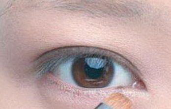 眼袋手术的恢复过程图「眼袋手术恢复过程图」