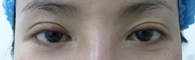 眼睛去皮手术恢复25天有增生吗(眼睛去皮手术恢复25天效果图)