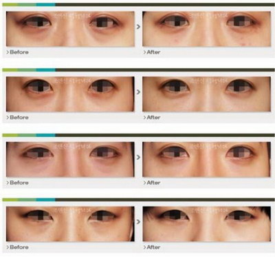 双眼皮是显性或隐形遗传(双眼皮显性还是隐形遗传)