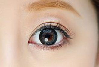双眼皮埋线多久可以戴美瞳_双眼皮埋线疤痕多久会消失