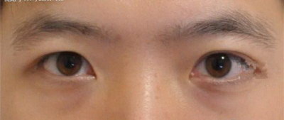 艾灸治疗黑眼圈眼袋的方法(什么是黑眼圈和眼袋)