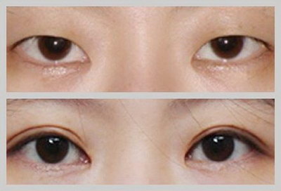 双眼皮恢复期一大一小正常吗
