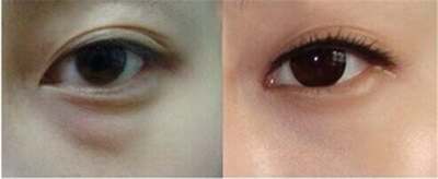眼综合手术大概需要多久能恢复_眼综合手术大概需要的时间
