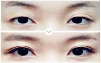 眼部除皱的方法究竟有哪些？