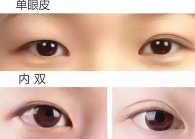 合肥韩式双眼皮成形术