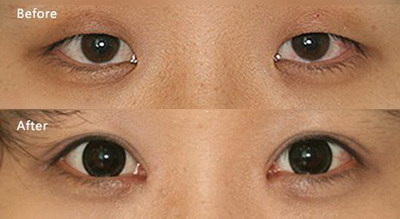 双眼视力最好是多少_双眼瞳孔大小不一样