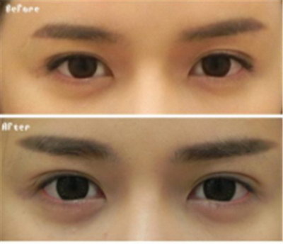 三点式双眼皮能保持多长时间