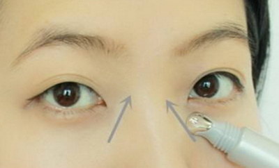 什么是切开双眼皮手术法？