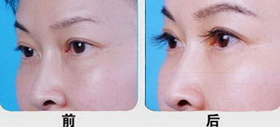 双眼皮增生疤痕可以用积雪苷霜软膏(什么是双眼皮增生疤痕？)