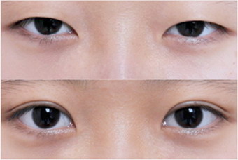 双眼皮手术多长时间能回复好_双眼皮做完后需要吃什么
