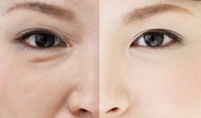 双眼皮术后该如何保护眼皮创口？
