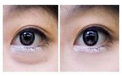 日式无痕双眼皮是什么_日式无痕双眼皮手术过程
