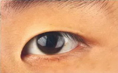 拉双眼皮是否有危害呢？