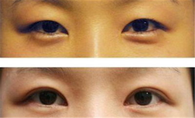 大小眼如何自然矫正_割双眼皮可以改善大小眼吗