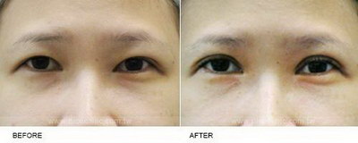 双眼皮预防增生(割双眼皮涂红霉素软膏能预防增生吗)