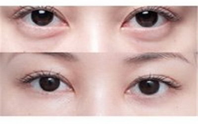 韩式双眼皮能把眼型做到完美的状态吗？