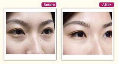 割双眼皮需要多长时间恢复期_割双眼皮前要注意事项有哪些