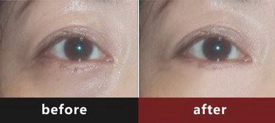 割的双眼皮多久会变窄_割的双眼皮多久可以完全恢复
