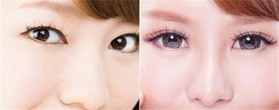 微创手术可以让我们拥有自然的双眼皮吗