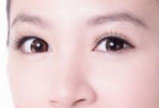 三点双眼皮恢复过程图解【韩式三点双眼皮的恢复过程】
