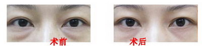眼睛经常有黑眼圈是什么原因