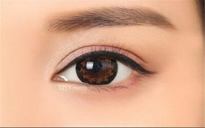 埋线双眼皮手术的效果_埋线双眼皮手术的原理