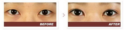 几种常见双眼皮手术方法比较