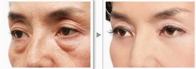 开眼角得多长时间才能恢复正常_开眼角的疤痕可以修复吗