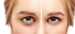 一只眼单眼皮一只眼双眼皮是怎么回事(为什么会出现一只眼单眼皮一只眼双眼皮？)