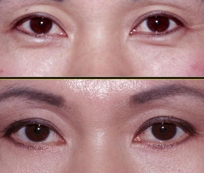 割双眼皮会影响眼睛吗「两边眼睛不一样割双眼皮有影响吗」