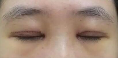 什么是韩式双眼皮手术(什么是韩式双眼皮手术韩式双眼皮)