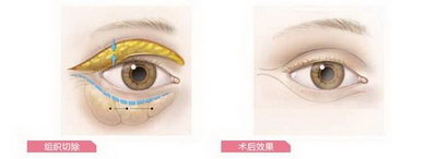 抽脂祛眼袋手术(做眼袋外切手术和抽脂哪一种更好)
