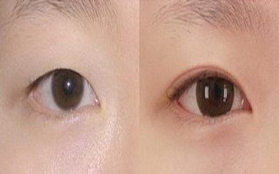 如何治疗眼睛巩膜泛黄【如何治疗眼睛长白粒】