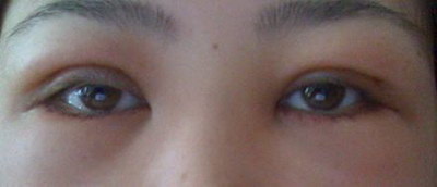 眼角膜薄是什么原因引起的_眼角膜薄是什么原因