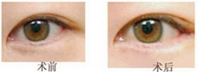 欧式眼的双眼皮_欧式平行双眼皮适合什么脸型