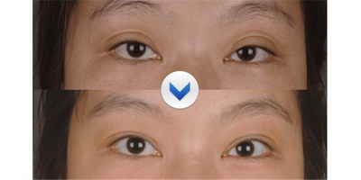重症肌无力眼睑下垂做什么检查(重症肌无力眼睑下垂怎么治疗)