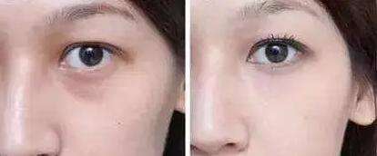 你知道韩式双眼皮术后多久才可以恢复吗？