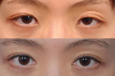 双眼皮手术事项有哪些_双眼皮手术是永久的吗