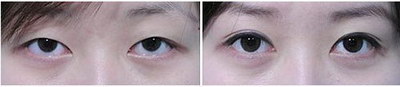 做了双眼皮眼角红印什么时候下去「做完双眼皮半个月眼角红是什么原因」
