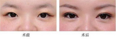 北京韩式双眼皮整形手术价格