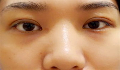 眼睑下垂有什么办法可以调整的_眼睑下垂眼皮松弛有什么办法吗