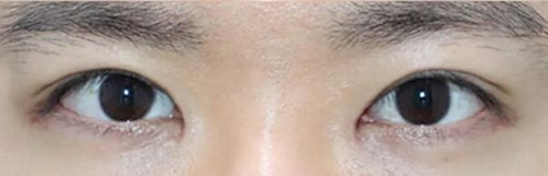 疤痕体质可以做双眼皮全切吗(疤痕体质可以埋线双眼皮吗)