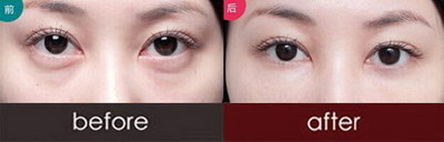 台州割双眼皮的后遗症_割双眼皮怎么选择眼型