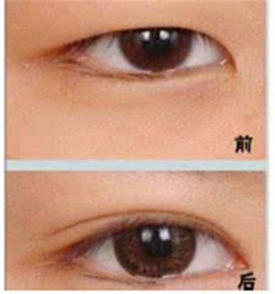 干眼症眼肿是怎么导致的_干眼症眼异物感是怎么导致的