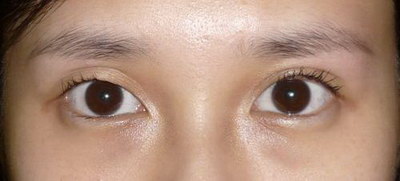 双眼皮手术修复前有哪些事项是需要特别注意的