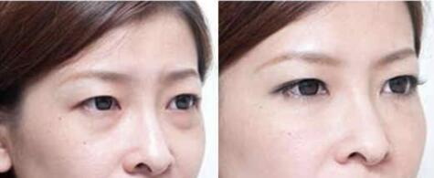 什么样的人不适合做美瞳线_双眼皮手术可以达到美瞳线的效果吗?
