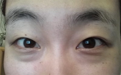 北京哪家割双眼皮医院比较好？