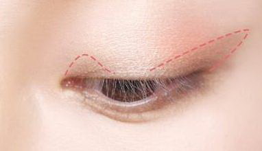 晶体植入近视眼手术散光(晶体植入近视眼手术多久可以正常工作)