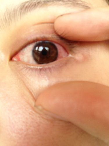 双眼皮修复肉条是怎么修复的_双眼皮修复手术和全切哪个好